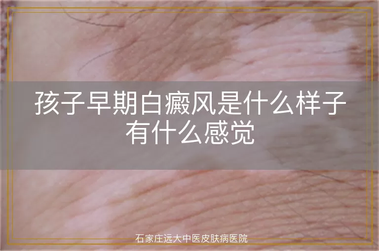 孩子早期白癜风是什么样子有什么感觉