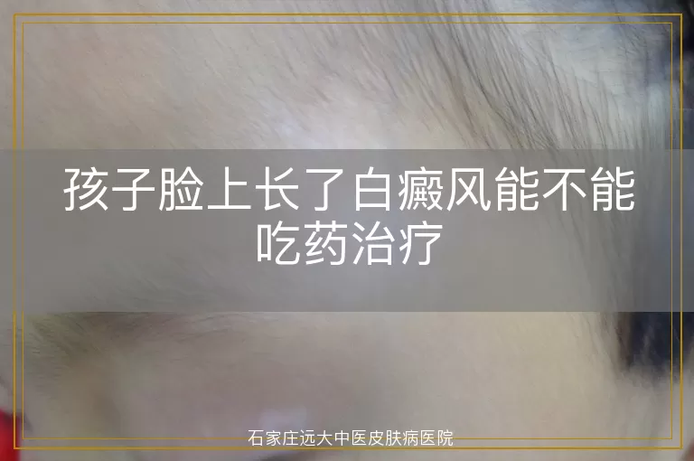 孩子脸上长了白癜风能不能吃药治疗