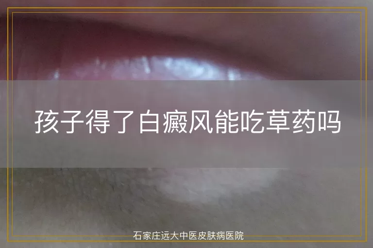 孩子得了白癜风能吃草药吗
