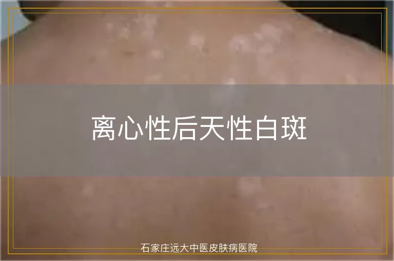 离心性后天性白斑