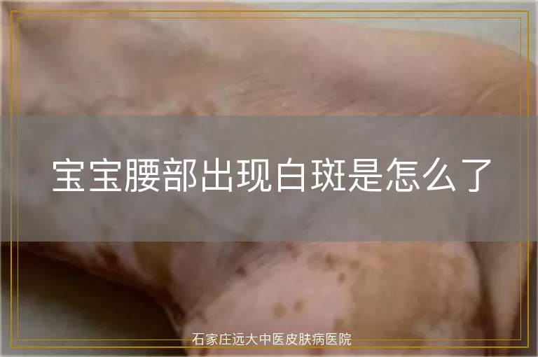 宝宝腰部出现白斑是怎么了