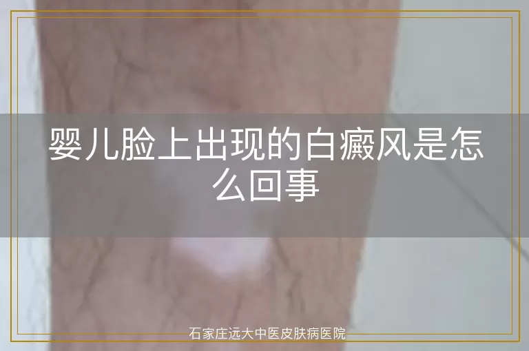 婴儿脸上出现的白癜风是怎么回事