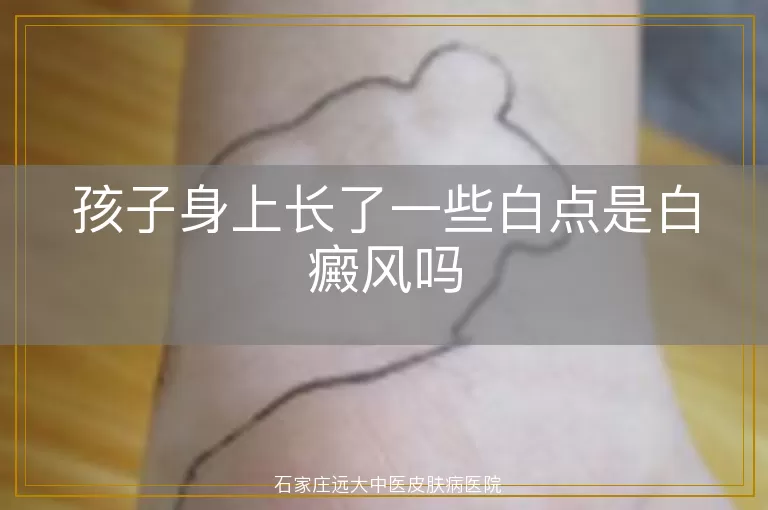孩子身上长了一些白点是白癜风吗