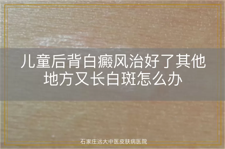 儿童后背白癜风治好了其他地方又长白斑怎么办