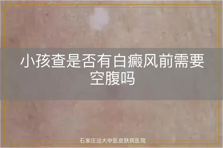 小孩查是否有白癜风前需要空腹吗