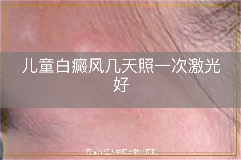 儿童白癜风几天照一次激光好