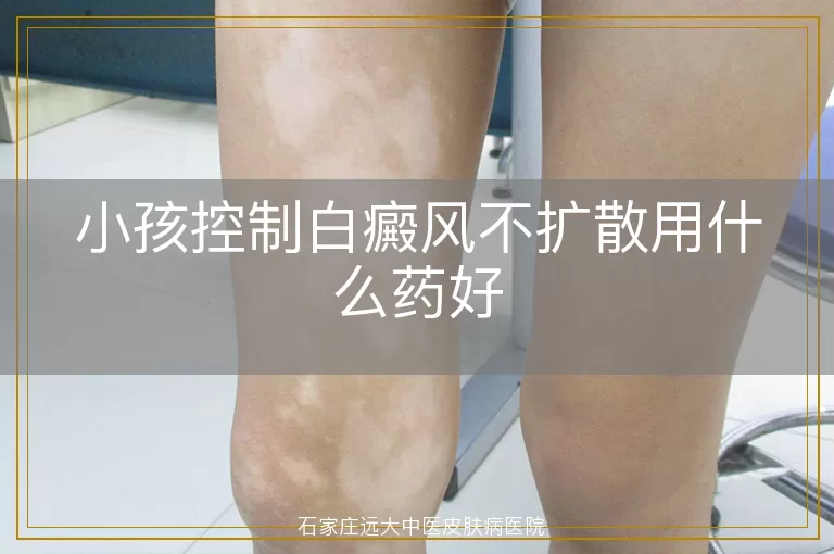 小孩控制白癜风不扩散用什么药好