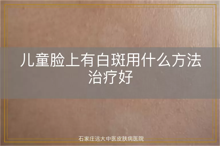 儿童脸上有白斑用什么方法治疗好