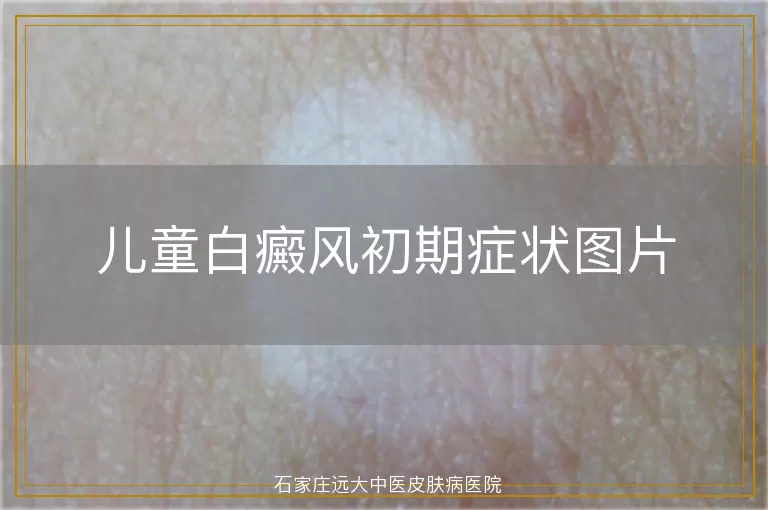 儿童白癜风初期症状图片