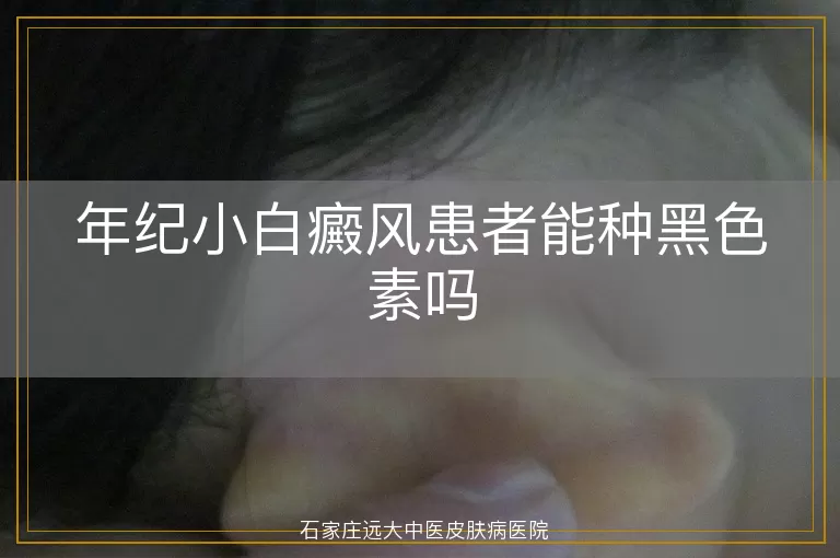 年纪小白癜风患者能种黑色素吗