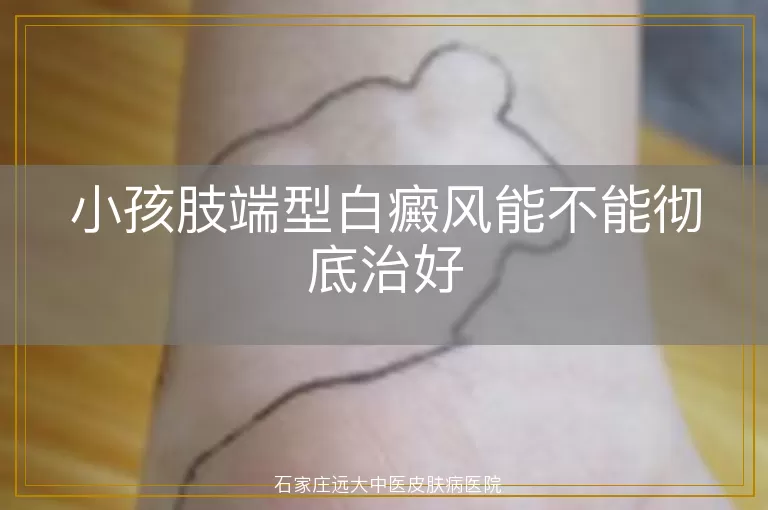 小孩肢端型白癜风能不能彻底治好