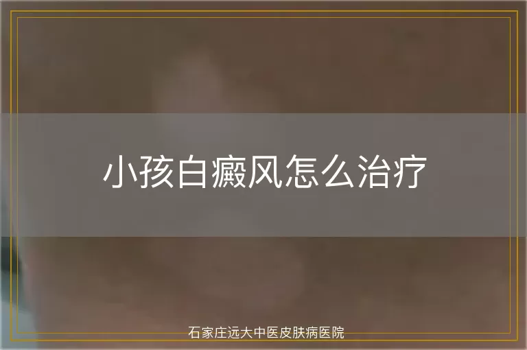 小孩白癜风怎么治疗