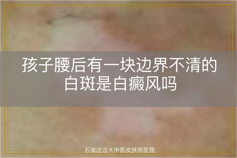 孩子腰后有一块边界不清的白斑是白癜风吗