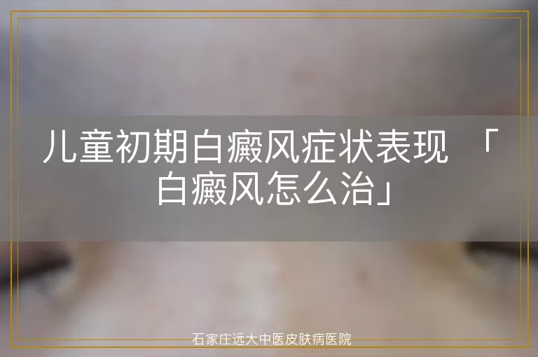 儿童初期白癜风症状表现 「白癜风怎么治」