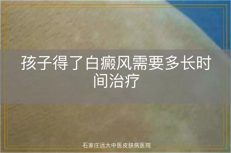孩子得了白癜风需要多长时间治疗