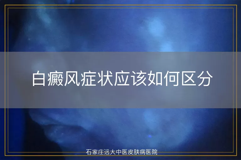 白癜风症状应该如何区分