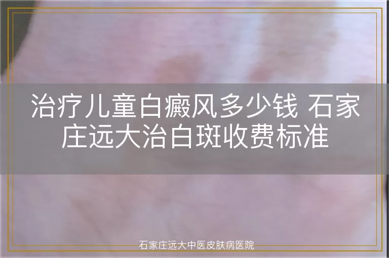 治疗儿童白癜风多少钱 石家庄远大治白斑收费标准