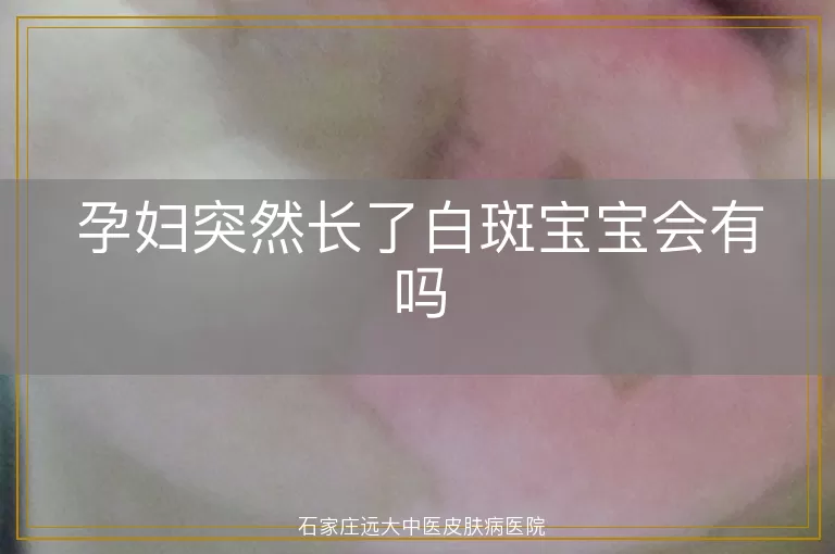 孕妇突然长了白斑宝宝会有吗