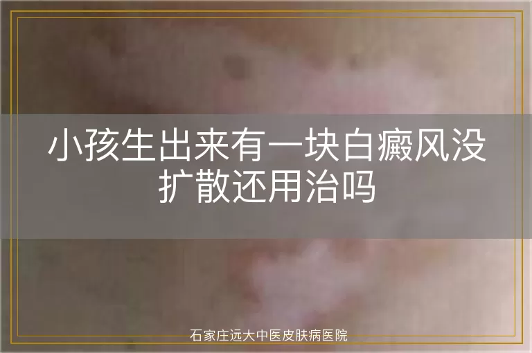 小孩生出来有一块白癜风没扩散还用治吗