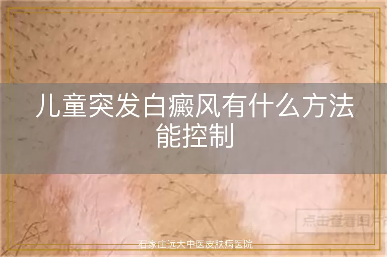 儿童突发白癜风有什么方法能控制