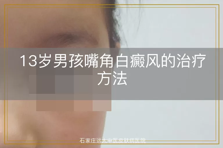 13岁男孩嘴角白癜风的治疗方法