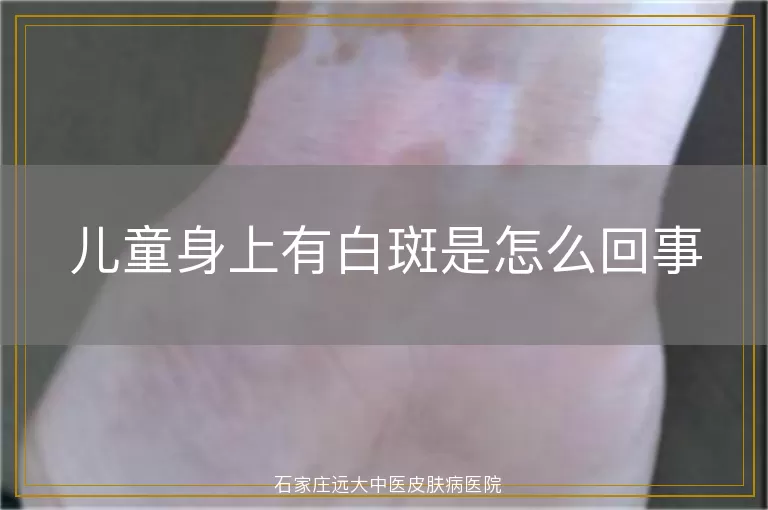 儿童身上有白斑是怎么回事