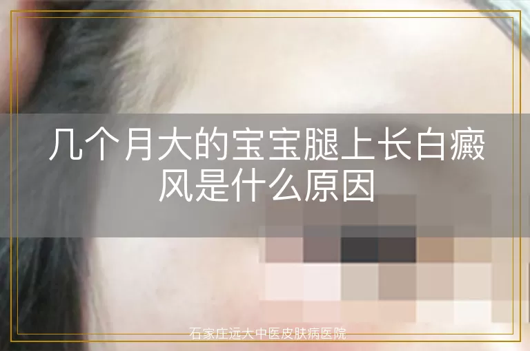 几个月大的宝宝腿上长白癜风是什么原因