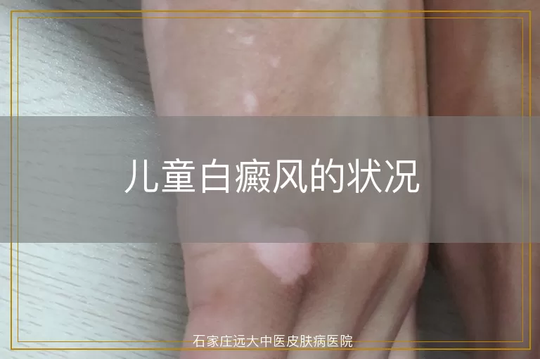 儿童白癜风的状况