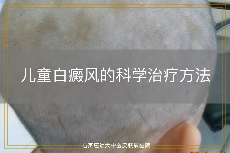 儿童白癜风的科学治疗方法