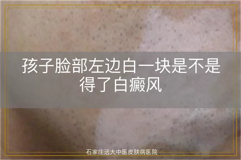 孩子脸部左边白一块是不是得了白癜风