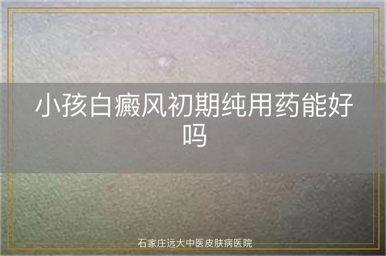 小孩白癜风初期纯用药能好吗