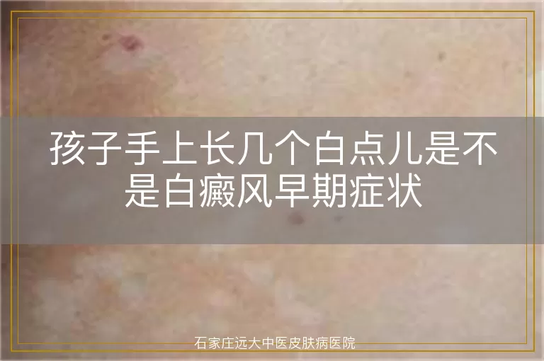 孩子手上长几个白点儿是不是白癜风早期症状