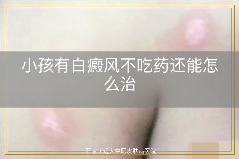 小孩有白癜风不吃药还能怎么治