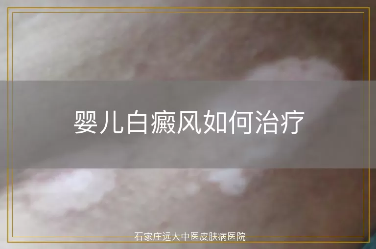 婴儿白癜风如何治疗