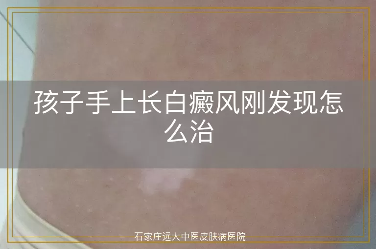 孩子手上长白癜风刚发现怎么治