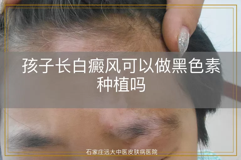 孩子长白癜风可以做黑色素种植吗