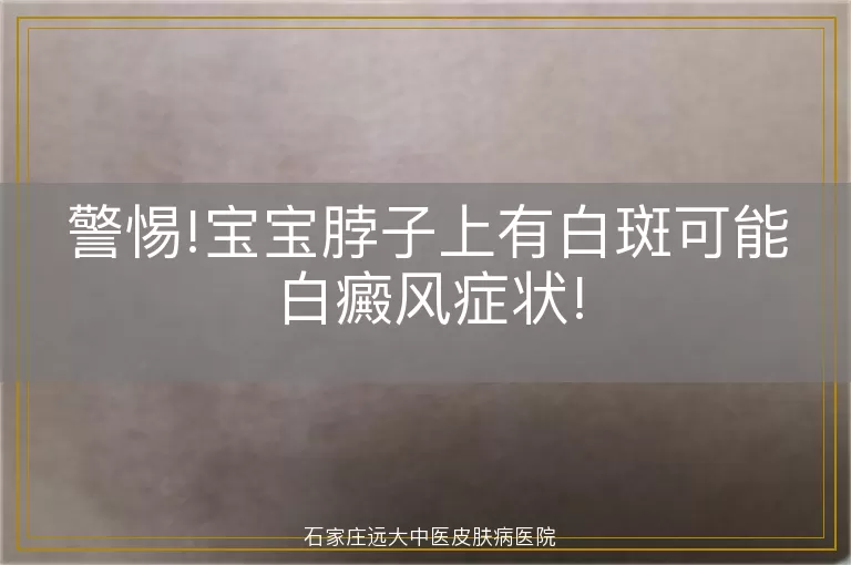 警惕!宝宝脖子上有白斑可能白癜风症状!