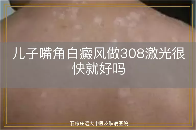 儿子嘴角白癜风做308激光很快就好吗