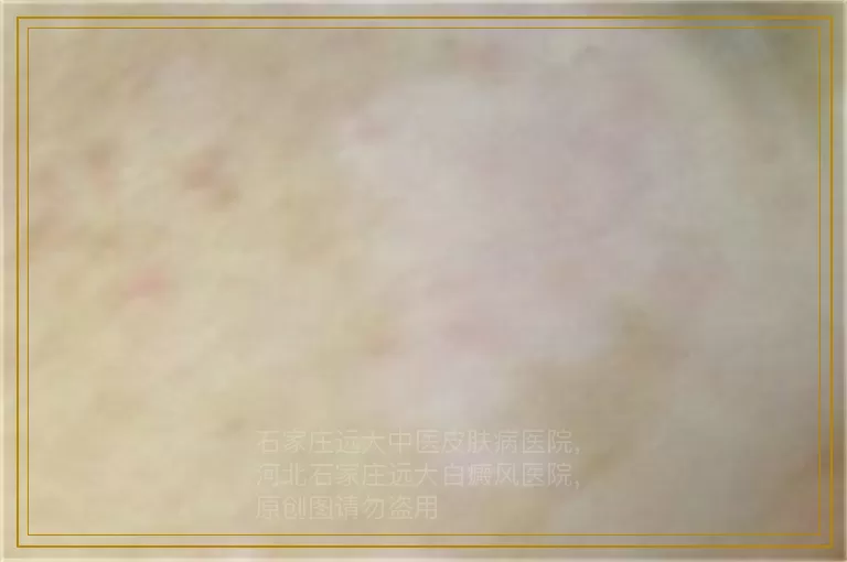 小孩皮肤上有一块变成白色是怎么回事