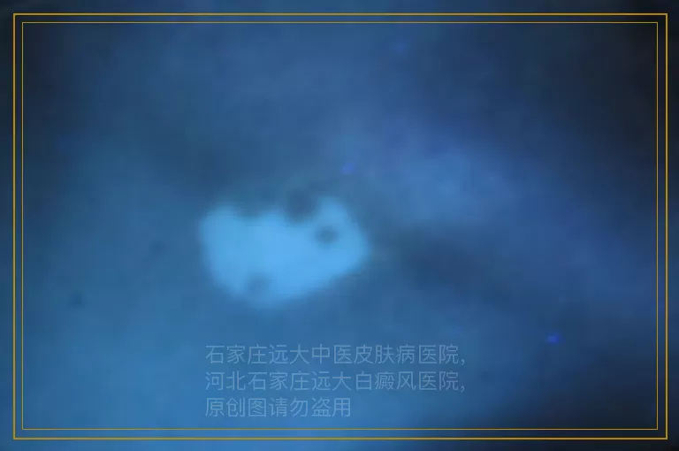 308激光治疗7岁的儿童白癜风好不好