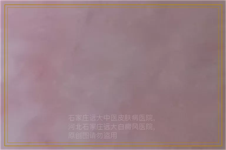 婴儿屁股有白癜风白斑怎么治