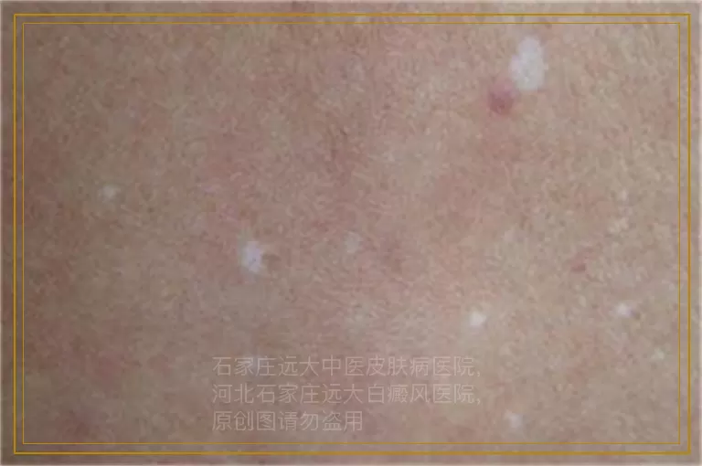 小孩脸上起白斑是什么原因