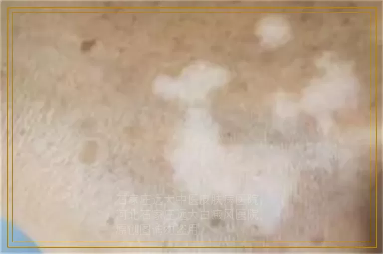 小孩嘴边一圈白是怎么回事