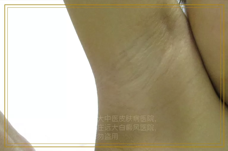 进展期白癜风的危险性