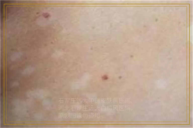 新生宝宝大腿内侧白斑