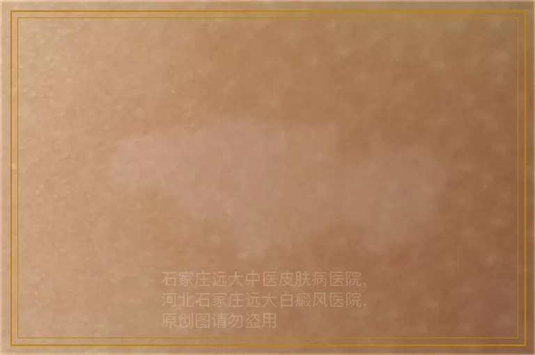 小孩子可以用补骨脂治疗白癜风吗