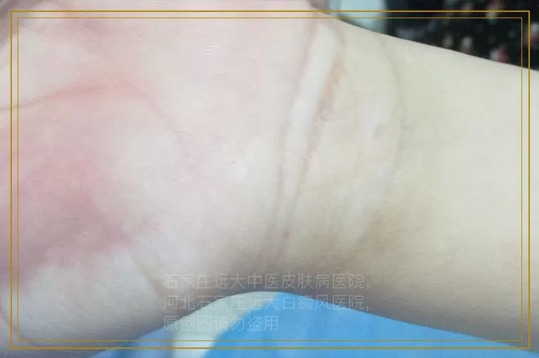 4岁宝宝脸上长淡白色白斑是为什么