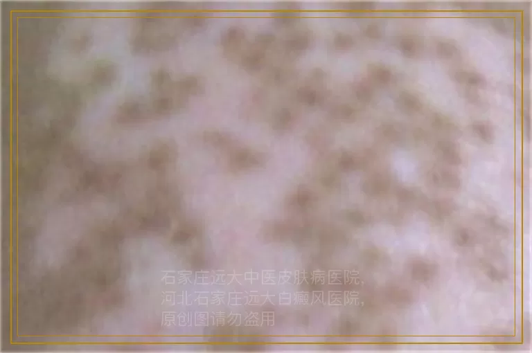 孩子胳膊上有块白斑能做植皮手术吗