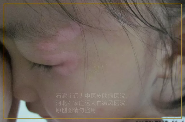 小孩脸上有一块很小的白斑近期变大了是什么