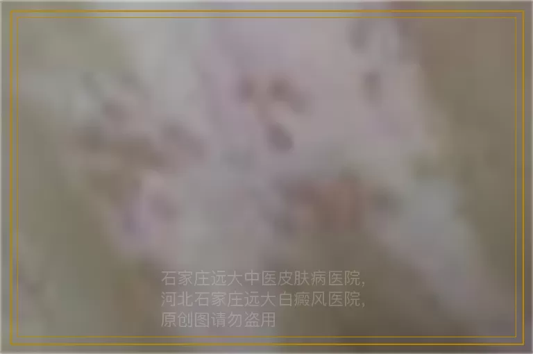 儿童头部白癜风怎么治疗